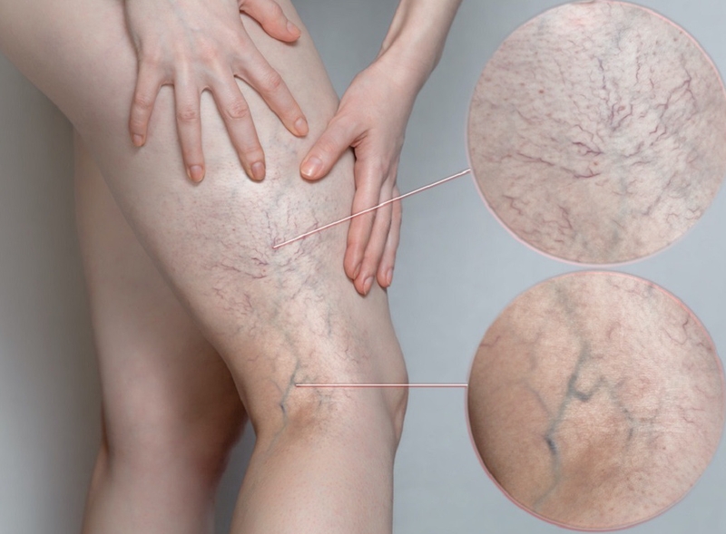 Chi phí chữa giãn tĩnh mạch bằng sóng cao tần không phải ai cũng biết 1