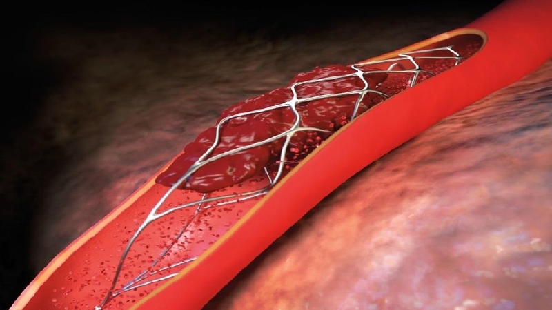 Stent được chế tạo từ lưới kim loại bền vững