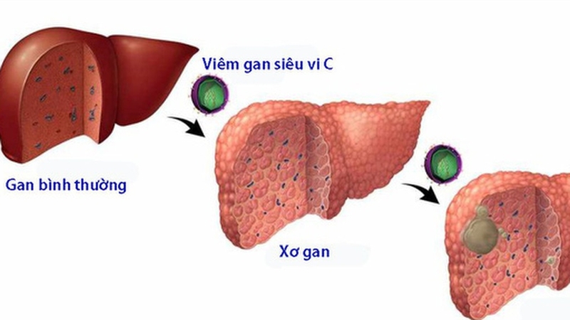 Chi phí điều trị viêm gan C: Những gì bạn cần biết để chuẩn bị tài chính 1