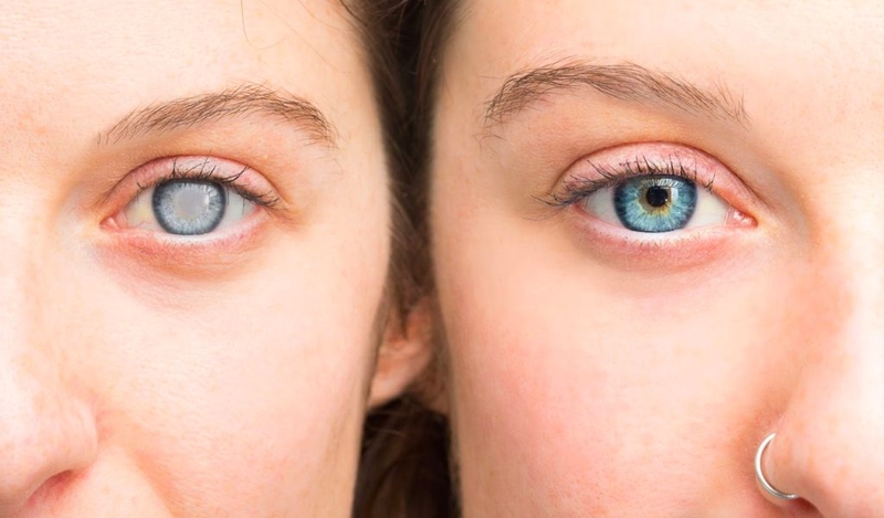 Chi phí mổ cườm mắt là bao nhiêu? Cần làm gì trước và sau khi phẫu thuật? 1