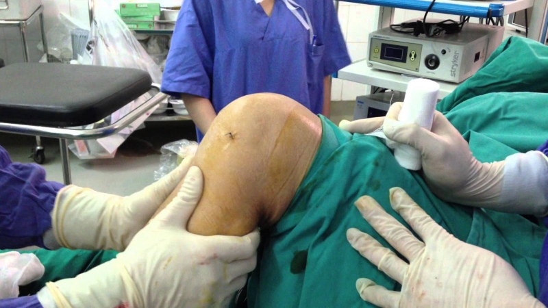 Chi phí mổ đứt dây chằng chéo trước có bảo hiểm theo đúng mức ưu đãi của loại bảo hiểm mà bệnh nhân có