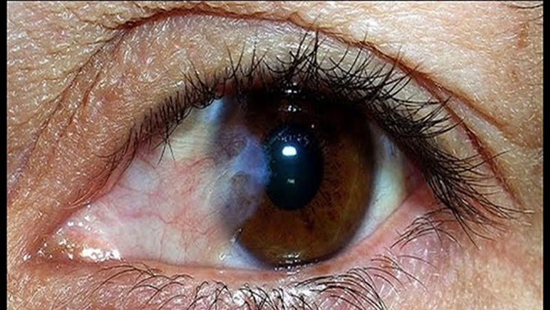 Chi phí mổ mộng thịt mắt có đắt không? 2