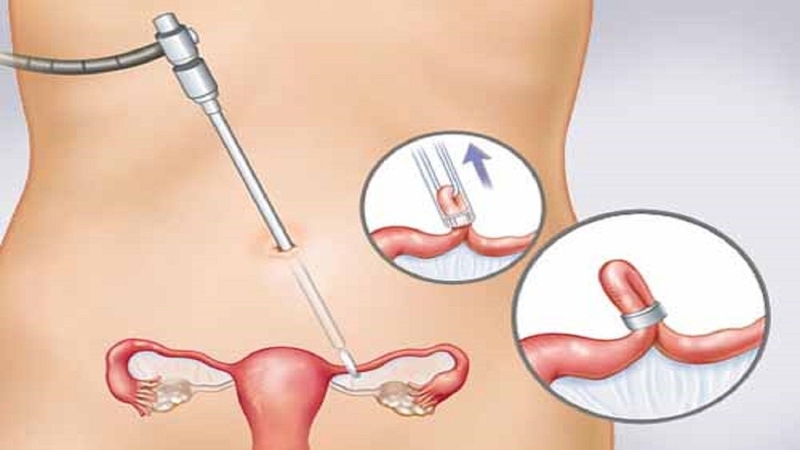 Mổ thông tắc vòi trứng được chỉ định khi điều trị nội khoa không hiệu quả