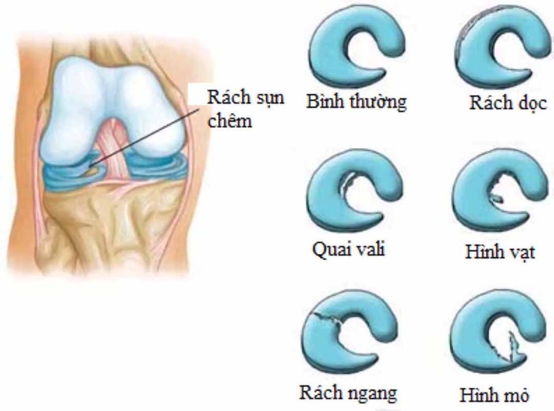 Chi phí mổ rách sụn chêm hết bao nhiêu1