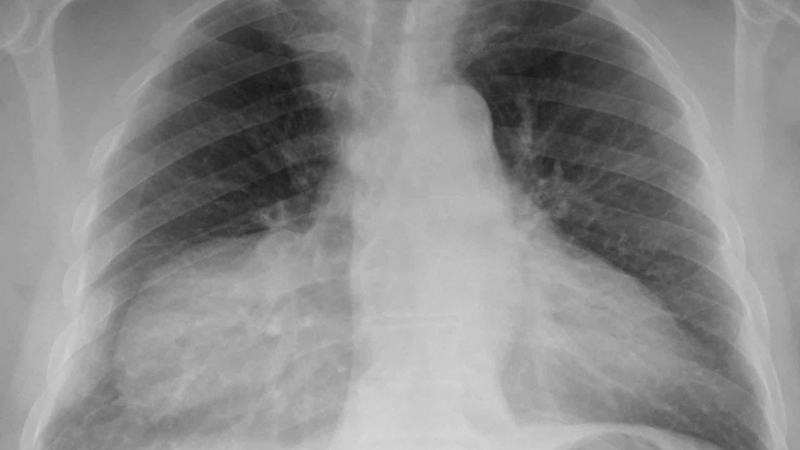 Chi phí mổ thoát vị hoành bẩm sinh: Cập nhật và hướng dẫn chi tiết 1