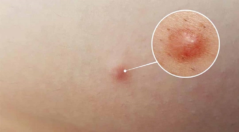 Chi phí mổ u bã đậu là bao nhiêu? Phương pháp điều trị u bã đậu hiệu quả nhất 2