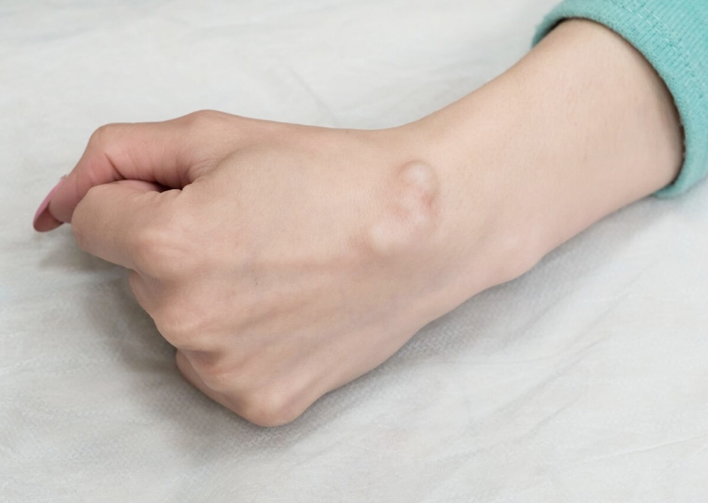 Chi phí mổ u nang bao hoạt dịch tầm bao nhiêu?