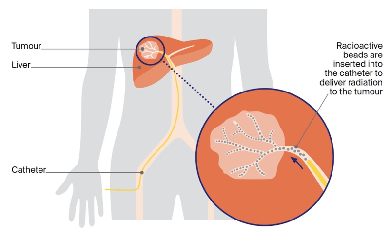 Chi phí nút mạch ung thư gan là bao nhiêu? Đánh giá hiệu quả của phương pháp 2