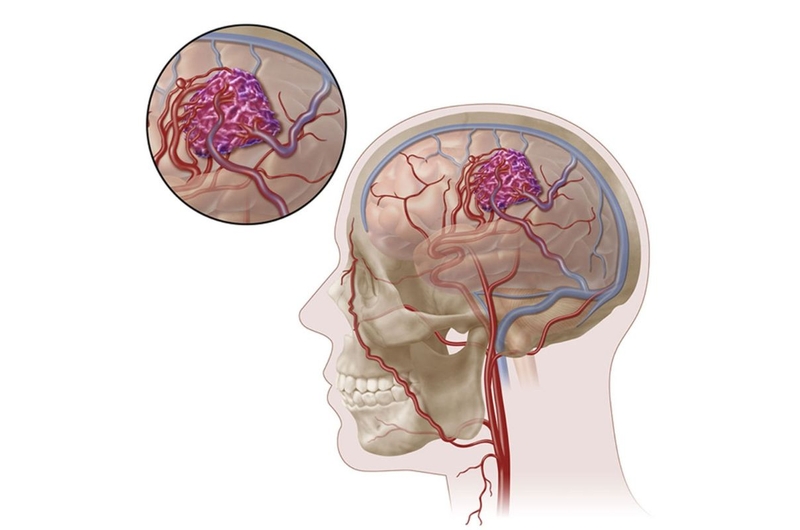 Chi phí phẫu thuật dị dạng mạch máu não khoảng bao nhiêu 1
