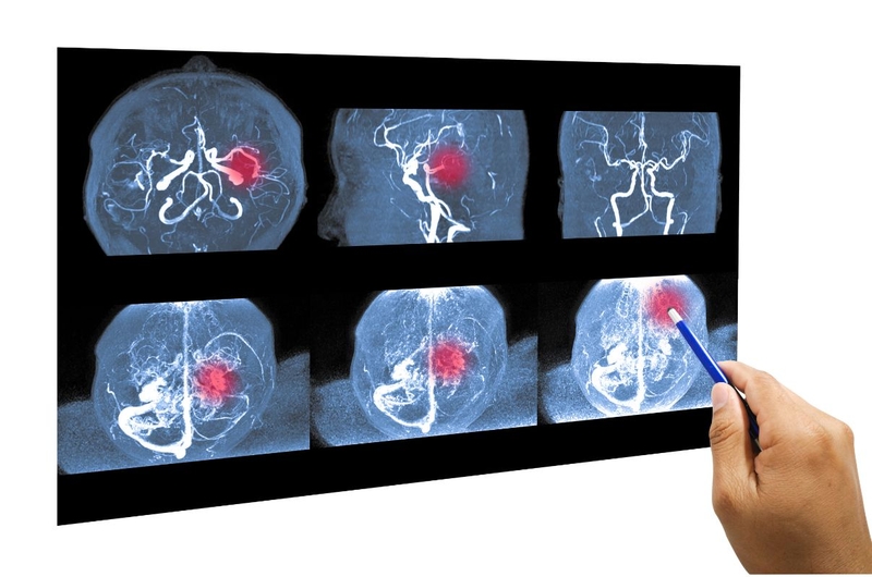 Chi phí phẫu thuật dị dạng mạch máu não khoảng bao nhiêu 2