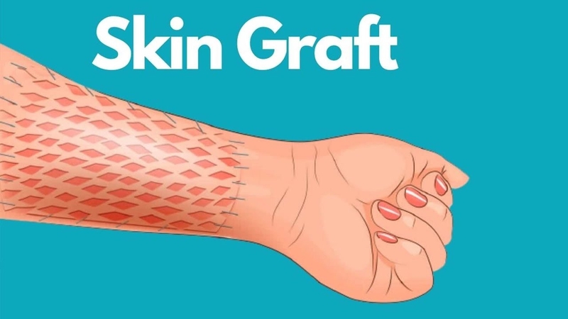 Chi phí phẫu thuật ghép da sẽ như thế nào? 2