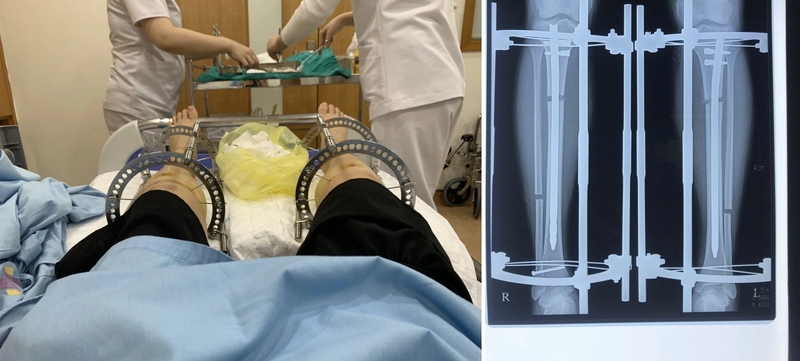 Chi phí phẫu thuật kéo dài chân là bao nhiêu? 1