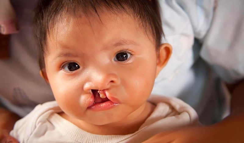 Chi phí phẫu thuật sứt môi hở hàm ếch? Cần chuẩn bị gì trước khi mổ? 1