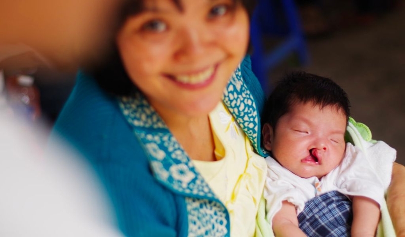 Chi phí phẫu thuật sứt môi hở hàm ếch? Cần chuẩn bị gì trước khi mổ? 2