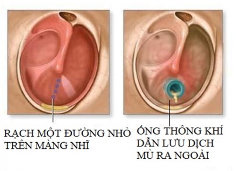Chi phí phẫu thuật viêm tai giữa bao nhiêu tiền?