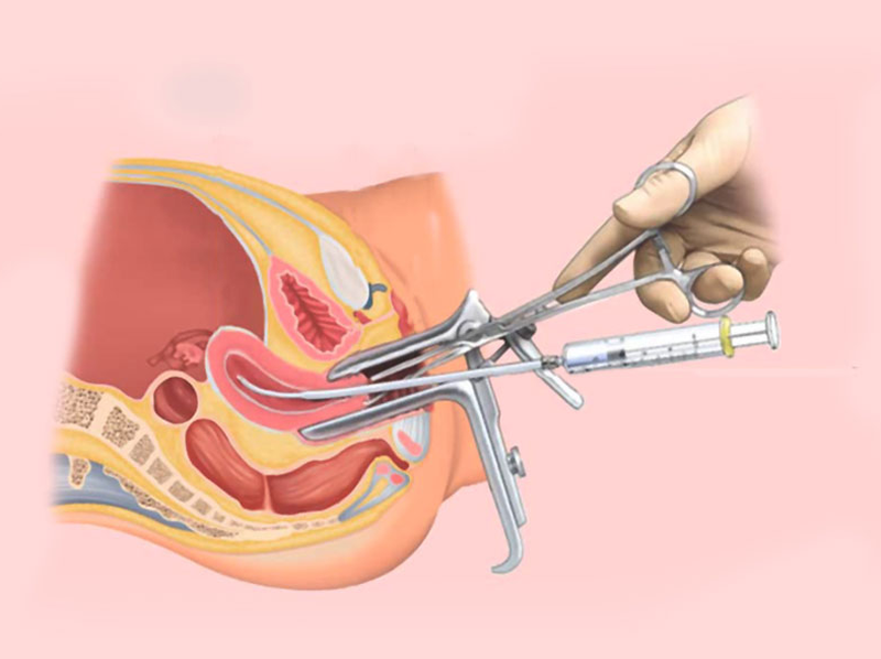 Chi phí sàng lọc tinh trùng sinh con trai là bao nhiêu? 2