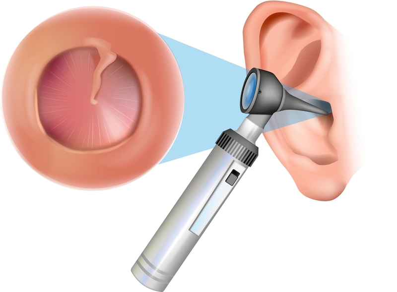 chi phí vá màng nhĩ 1