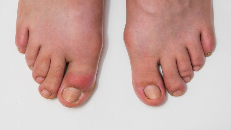 Nồng độ acid uric tăng cao kéo dài có thể gây bệnh gout