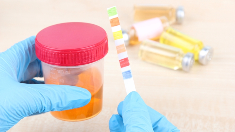 Chỉ số albumin trong nước tiểu cao: Dấu hiệu cảnh báo sớm các bệnh lý nguy hiểm 1