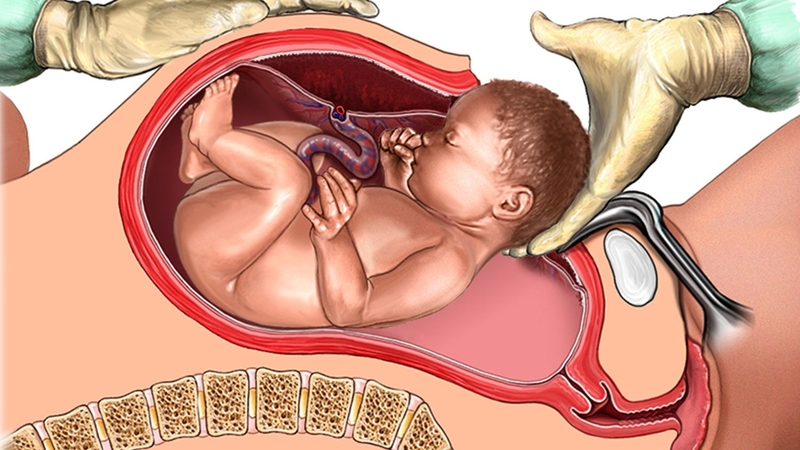 Chỉ số Bishop là gì trong sản khoa? Chỉ số này có ý nghĩa như thế nào? 3