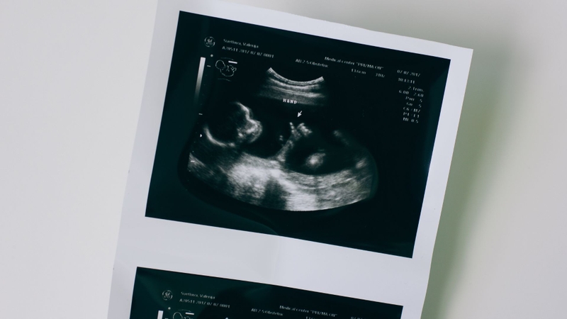 Chỉ số đường kính lưỡng đỉnh thai 36 tuần như thế nào là bình thường?-1