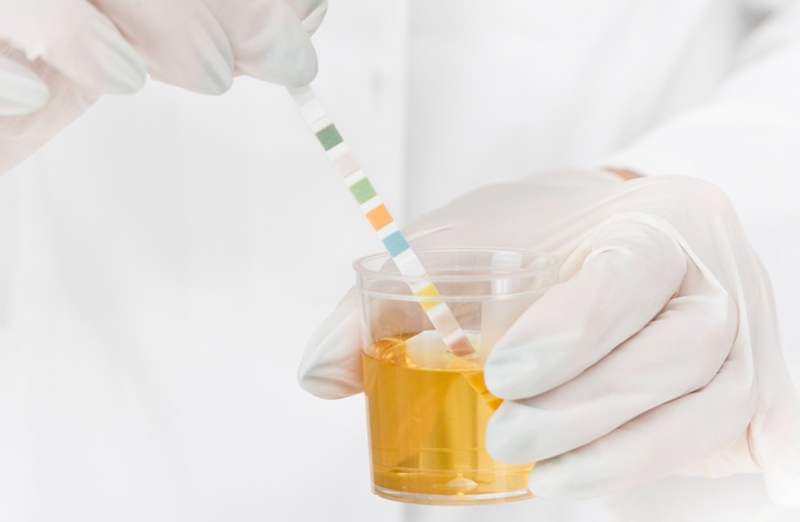 Chỉ số ERY trong nước tiểu là gì? Cách đọc các chỉ số xét nghiệm nước tiểu 3