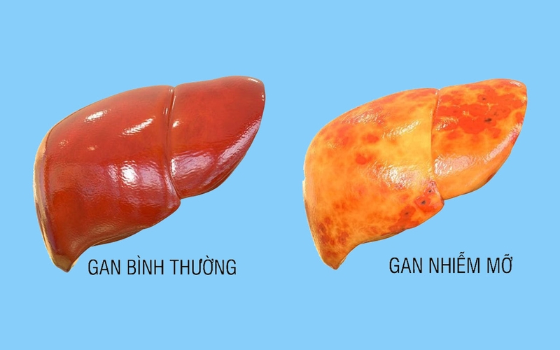 Gan nhiễm mỡ là tình trạng mỡ tích tụ ở gan trong một thời gian.