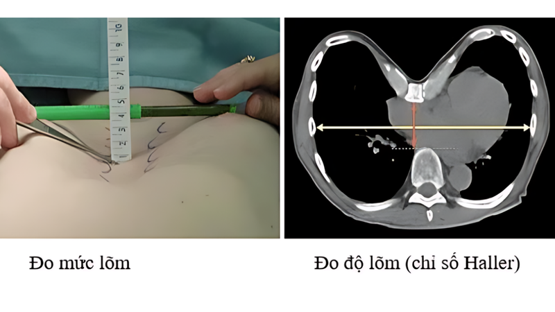 Chỉ số Haller là gì? Vai trò của chỉ số Haller trong điều trị lõm ngực 1