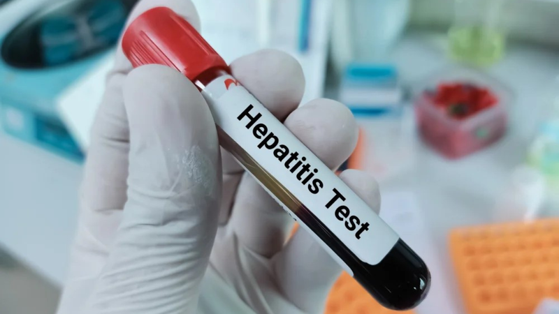 Chỉ số HbsAg là gì? Cách đọc kết quả xét nghiệm HBsAg 4
