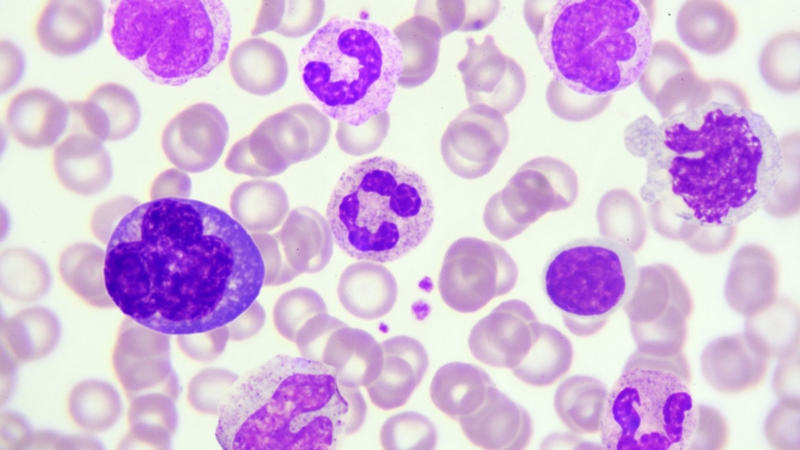 Chỉ số leu trong nước tiểu là 125 có nguy hiểm không? Cách xử trí 1