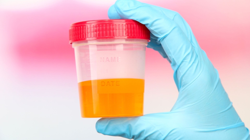 Chỉ số leu trong nước tiểu là 125 có nguy hiểm không? Cách xử trí 3