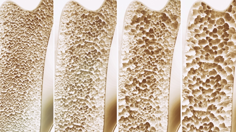 Chỉ số loãng xương là bao nhiêu? 1