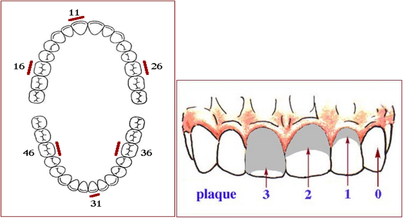 Chỉ số mảng bám Plaque index là gì?-1