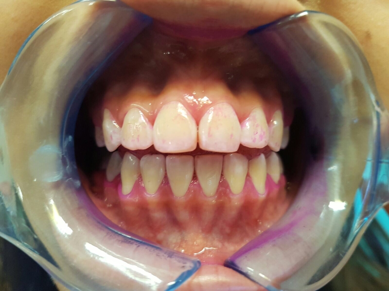 Chỉ số mảng bám Plaque index là gì?-3