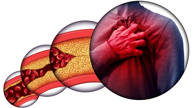 Chỉ số mỡ máu Triglyceride là gì và các biến chứng nguy hiểm 4