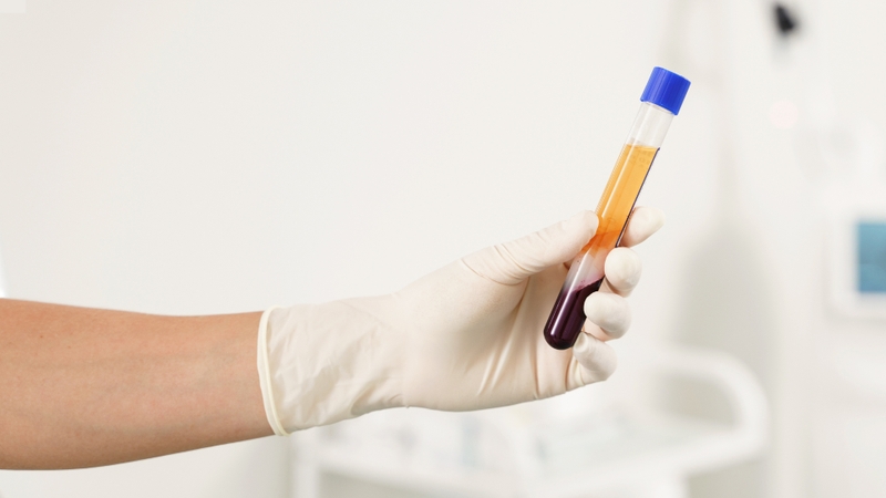 Chỉ số P-LCC thấp là bệnh gì? Các chỉ số xét nghiệm liên quan đến tiểu cầu 2