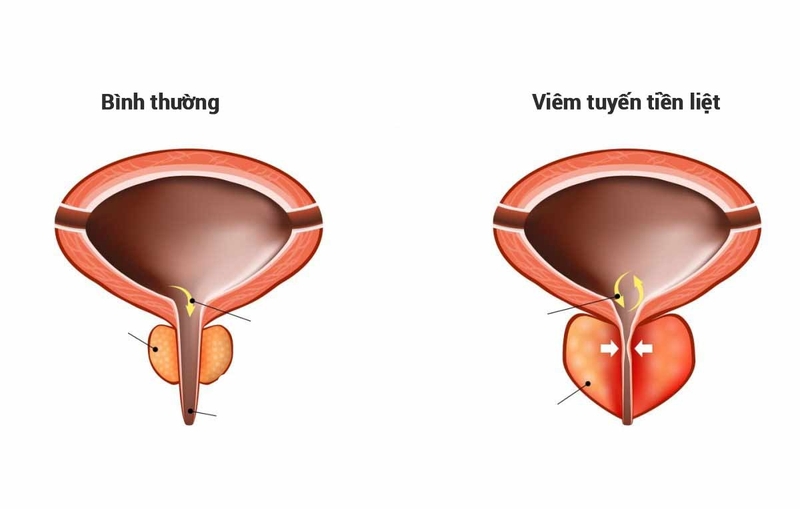 Chỉ số PSA cao có báo hiệu bệnh gì không? -3