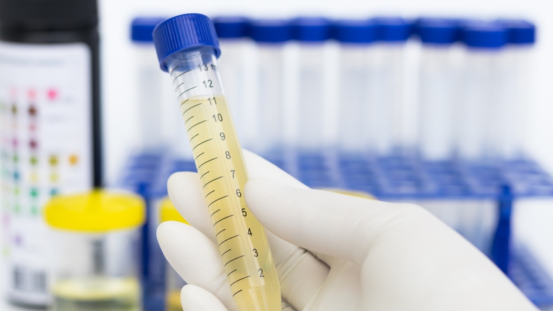 Chỉ số SG trong nước tiểu cao: Dấu hiệu cảnh báo sức khỏe bạn không nên bỏ qua 1