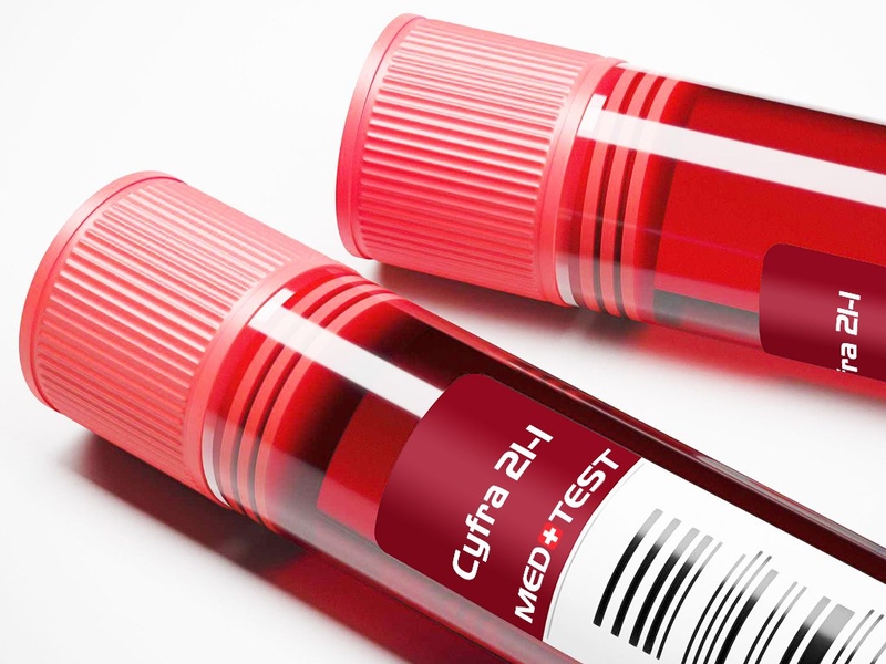 Chỉ số xét nghiệm cyfra 21 - 1 dương tính giả trong trường hợp nào?1