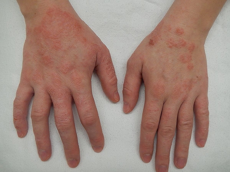 Chi tiết cách chữa hắc lào bằng muối cực hiệu quả 3