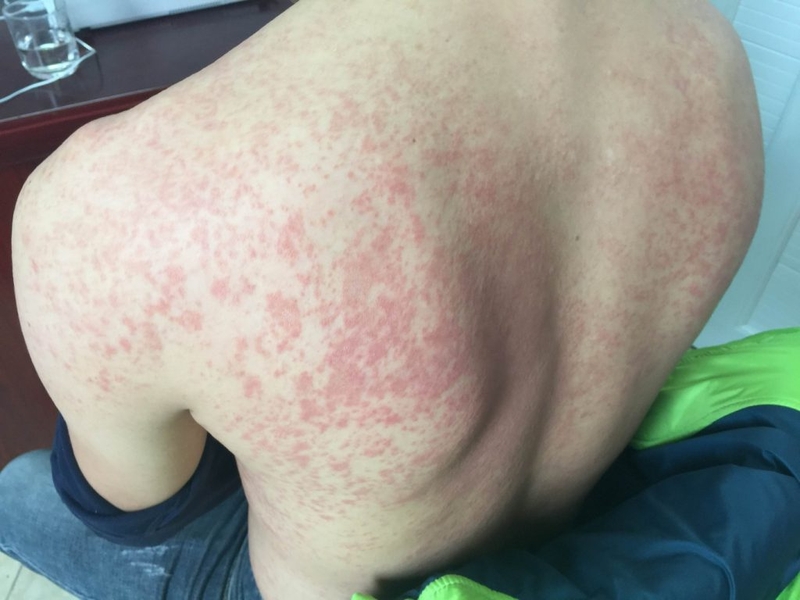 Chia sẻ kinh nghiệm về bệnh dị ứng da và cách điều trị 1