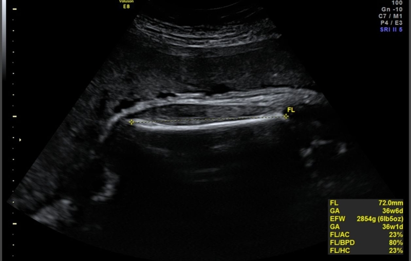 Giải đáp băn khoăn của mẹ bầu: Chiều dài xương đùi thai 36 tuần là bao nhiêu 2