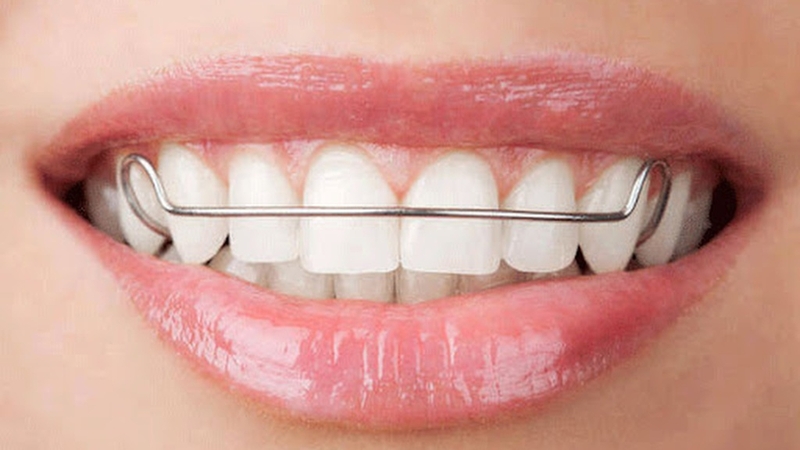 Chỉnh nha là gì? Các phương pháp chỉnh nha phổ biến hiện nay 3