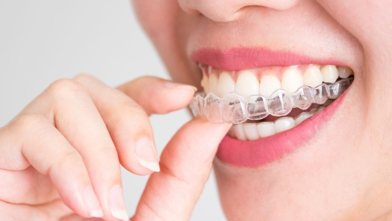 Chỉnh nha là gì? Các phương pháp chỉnh nha phổ biến hiện nay 5