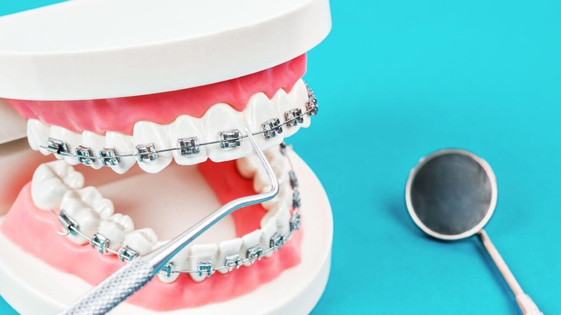 Chỉnh nha là gì? Các phương pháp chỉnh nha phổ biến hiện nay 4