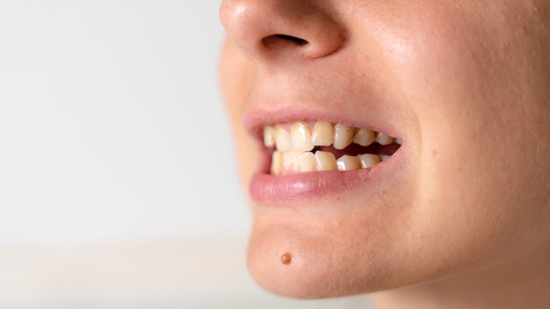 Chỉnh răng khểnh không niềng có được không? Chi phí bao nhiêu3