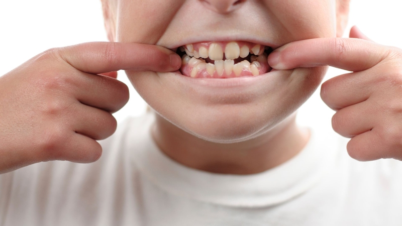 Chỉnh răng khểnh không niềng có được không? Chi phí bao nhiêu1