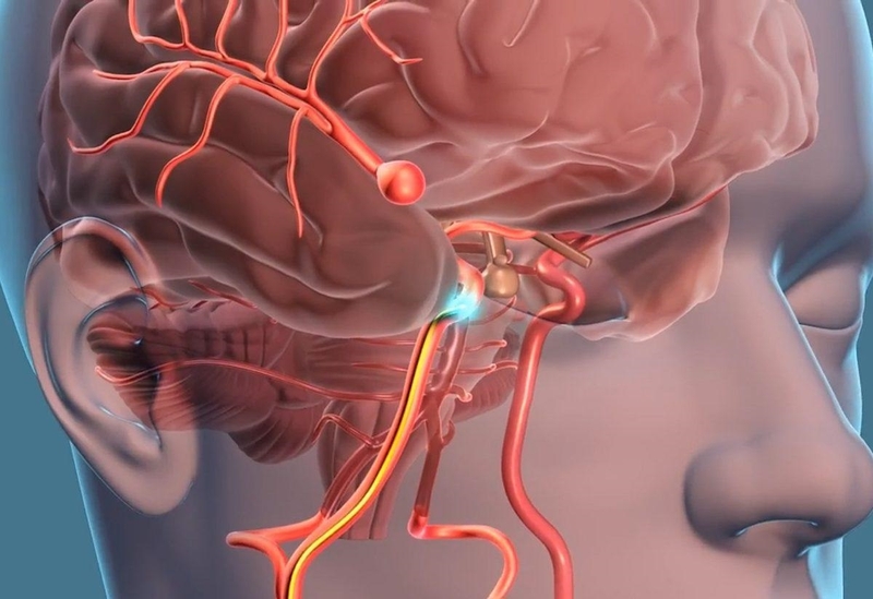 Chớ coi thường: Dấu hiệu và nguyên nhân đột quỵ ở người trẻ tuổi 1