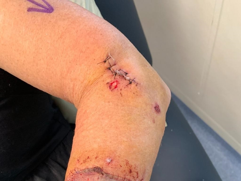 chó đã được tiêm phòng dại cắn có sao không 2