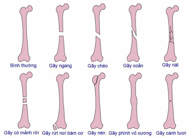 Chỗ gãy xương bị sưng phải làm sao 1